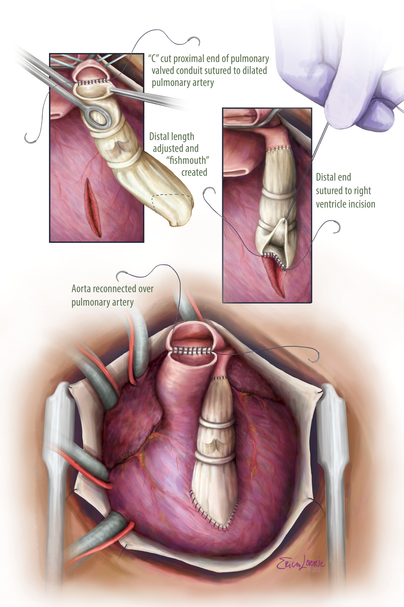 Rastelli Procedure for Pulmonary Atresia – Erica Lorrie